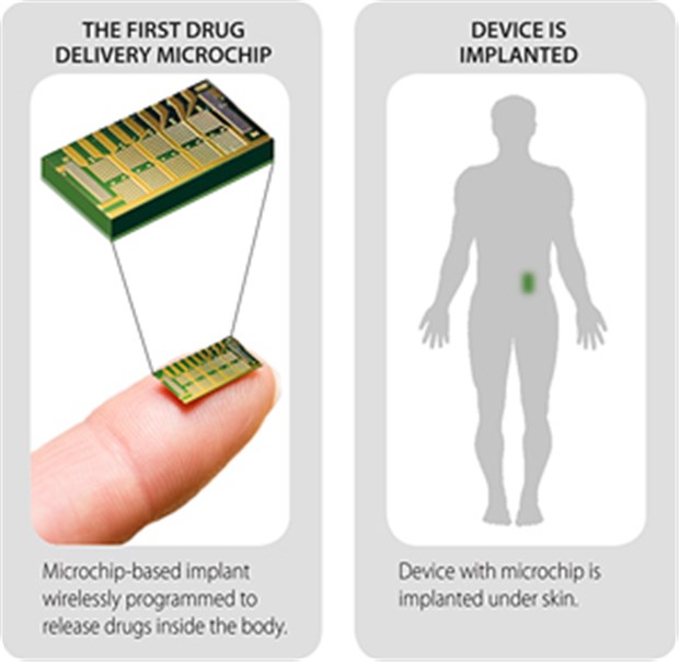 Microchip - nicht größer als ein Fingernagel - wird unter der Haut implantiert und kann per Fernsteuerung Medikamente im Körper freisetzen.