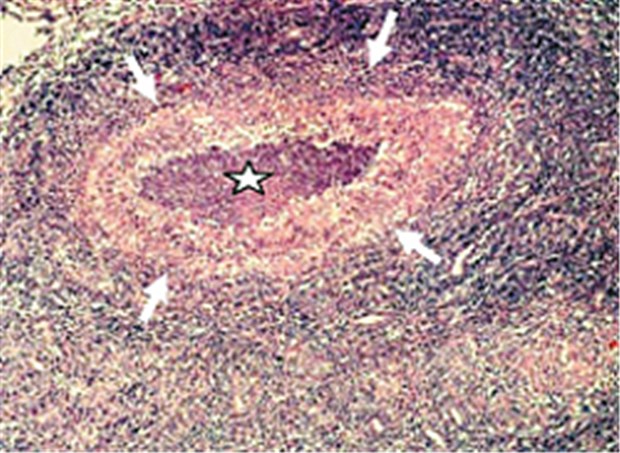 Hasenpest ist selten - doch es gibt sie noch Mikroabszess mit zentraler Nekrose (Stern) und Begrenzung durch radiär ausgerichtete Epitheloidzellen und Histiozyten (Pfeile).