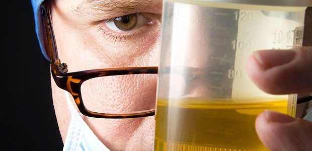 Kein Alarmzeichen für Krebs! Mikrohämaturie - nicht mit bloßem Auge, sondern unter dem Mikroskop zu erkennen.