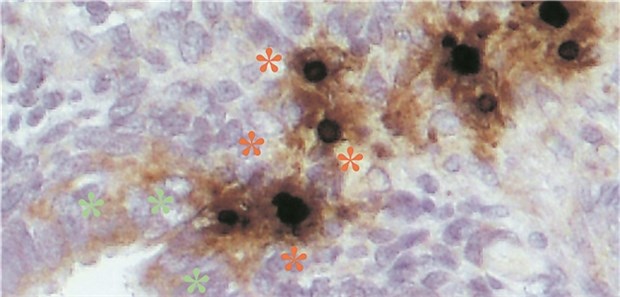 Mikroskopische Aufnahme: Das Molekül „PreImplantation Factor“ (grün) moduliert die Immunzellen (rot) in der Endometriose. Von dem in der Schwangerschaft produzierten Molekül gibt es eine synthetische Variante.