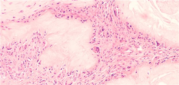 Mikroskopische Aufnahme eines Gichttophus bei einem Gichtpatienten mit hohem Harnsäurespiegel im Blut. (Beispielbild)

