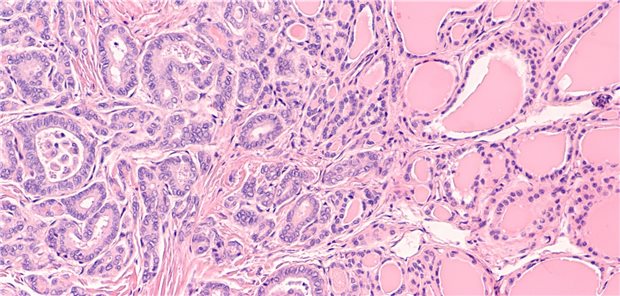 Mikroskopische Aufnahme eines papillären Schilddrüsenkarzinoms, follikuläre Variante. 