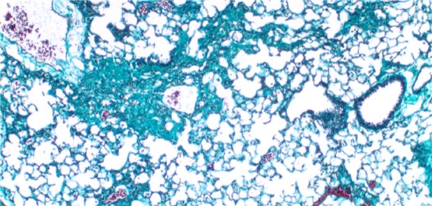 Mikroskopische Aufnahme von Lungengewebe, welches von Fibrose (türkis) betroffen ist. Forschende der Universitätsmedizin Mainz haben einen bisher unbekannten Mechanismus entdeckt, der die Entstehung von Lungenfibrose begünstigt. Dabei sind Histone maßgeblich beteiligt.