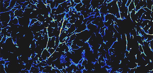 Tie1 – Neues Konzept, um Tumorwachstum zu verhindern Mikroskopische Darstellung des dichten Netzes von Blutgefäßen in einem wachsenden Tumor: Durch Hemmung des Rezeptors Tie1 gelang es Wissenschaftlern, die Blutgefäße nicht mehr wachsen zu lassen.