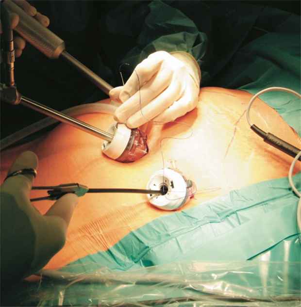 Besonders jungen Adipösen hilft Chirurgie Minimalinvasive Magenband-Operation: Adipositas-Zentren sollten jährlich mindestens 125 der schwierigen Eingriffe machen. © Carsten Kattau / fotolia.com