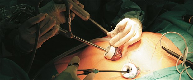 Die Adipositas-Chirurgie bewährt sich in der Praxis Minimalinvasiver Einsatz eines Magenbands.