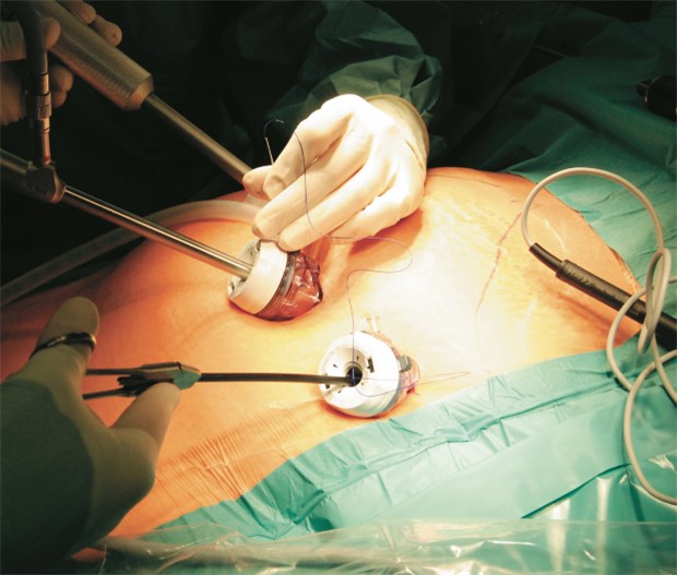 Magenband: Eine Option für schwer adipöse Jugendliche? Minimalinvasiver Einsatz eines Magenbands. © Carsten Kattau/fotolia.com