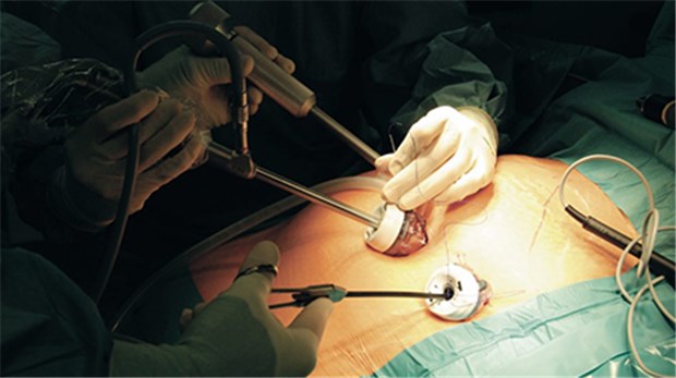 Plädoyer für Adipositas-Chirurgie als Therapieoption Minimalinvasiver Einsatz eines Magenbands: Experten beklagen, dass zu wenigen Menschen von dieser Intervention profitieren.