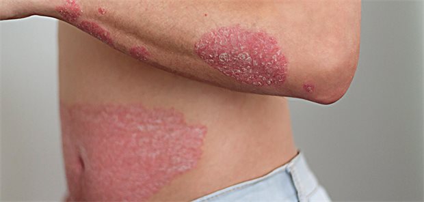 Psoriasis-Plaques am Bauch und Unterarm eines jungen Mannes.