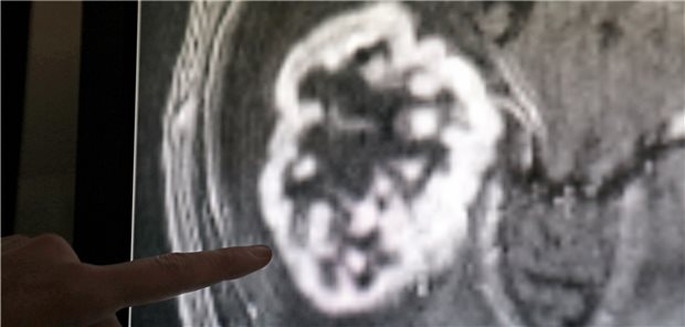 Mit Hilfe der Magnetresonanztomographie wird ein Tumor festgestellt. 