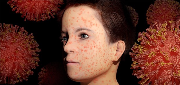 Mit Masern kann man sich noch in einem Raum anstecken, den ein Infizierter zwei Stunden vorher verlassen hat.