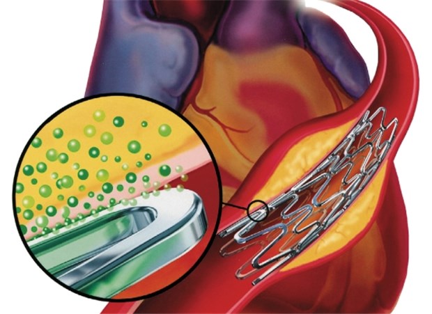 Ist das Rätsel der späten Stentthrombosen gelöst? Mit Medikamenten beschichtete Koronarstents setzen Wirkstoffe zur Hemmung der reaktiven Intimahyperplasie direkt an der Gefäßwand frei.