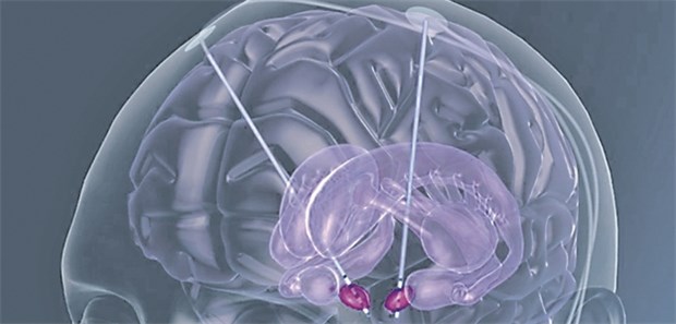 Mit Tiefer Hirnstimulation nahmen Depressionen nicht zu.