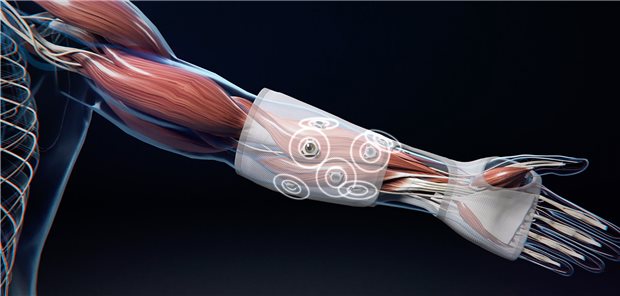 Mit bis zu zwölf Mikroimplantaten könnten die Muskeln des Unterarms stimuliert und so bis zu acht Handbewegungen wiederhergestellt werden, teilt die Fraunhofer-Gesellschaft mit.