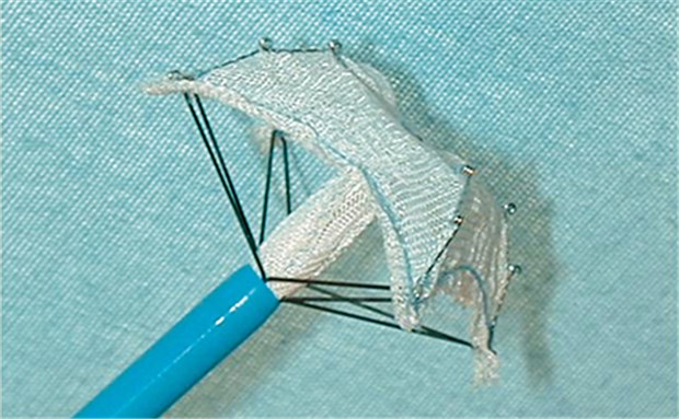 Septum-Verschluss: kein Schutz vor Apoplexie Mit dem Schirmchen STARFlex® lässt sich ein offenes Foramen ovale mit einem perkutanen Katheter-Eingriff minimalinvasiv verschließen.
