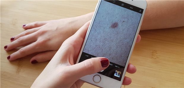 Mit dem Smartphone nimmt eine Frau auffällige Hautstellen auf, die dann per Telemedizin von einem Dermatologen bewertet werden können. Zwar ließen sich viele dermatologische Fragestellungen auch online bearbeiten. Aber das gelte das nicht für alle Erkrankungen, wurde jetzt bei einer Dermatologen-Tagung in Wiesbaden betont.