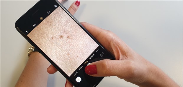 Mit dem Smartphone nimmt eine Patienten auffällige Hautstellen auf, die dann per Telemedizin von einem Dermatologen bewertet werden.