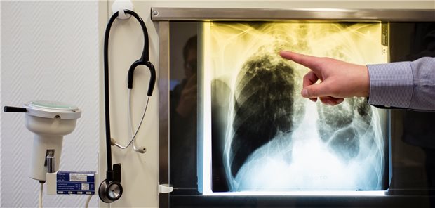 Vertragsärzte bei ASV im Nachteil Mit der Indikation Tuberkulose ist die ambulante spezialfachärztliche Versorgung vor acht Jahren gestartet.