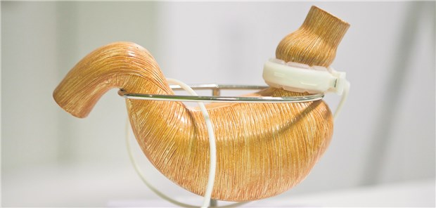 Diabetiker haben weniger Herzinfarkte nach Adipositas-Op! Mit diesem Modell wird in der Adipositas-Klinik IPCO in Mulhouse (Frankreich) das Magenband zur Gewichtsreduktion demonstriert.