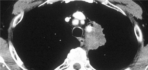 Mit einem Thorax-CT lassen sich einer Studie zufolge mehr Rezidive und neue Primärtumoren bei Patientinnen und Patienten mit NSCLC erkennen.

