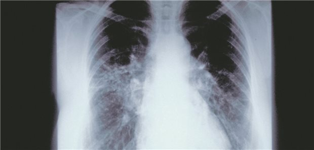 Mit einem individuellen Heilversuch besserten sich die Symptome einer 38-jährigen Patienten mit Sklerose-bedingter Lungenfibrose. (Symbolbild)