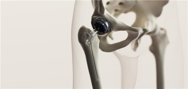 Mit einer Brustkrebserkrankung in der Vorgeschichte verdoppelte sich das Komplikationsrisiko bei Implantation eines Hüftgelenksersatzes, vor allem intraoperative Frakturen (2,4 Prozent vs. 1,4 Prozent) und venöse Thromboembolien (1,4 Prozent vs. 0,5 Prozent) wurden häufiger beobachtet.