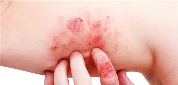 Atopische Dermatitis (AD), auch bekannt als atopisches Ekzem, eine Art von Entzündung der Haut am Arm eines Patienten.