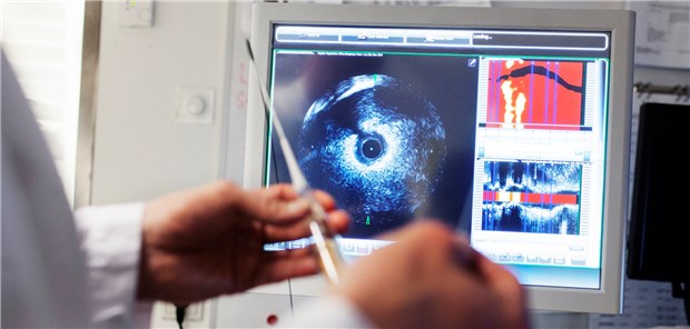 Mit intrakoronarer Bildgebung gelingt es gut, unterschiedliche Pathogenesen beim akuten Koronarsyndrom abzugrenzen.