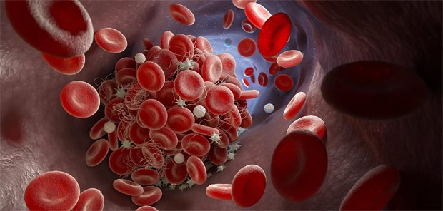 Thrombus im Gefäß