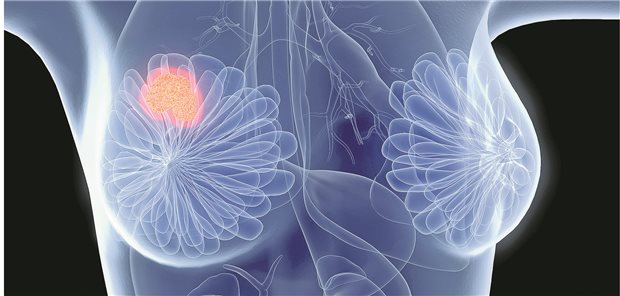 Mit welcher bildgebenden Screening-Methode lässt sich Brustkrebs bei Frauen mit dichtem Brustgewebe am besten erkennen? Dieser Frage ging ein kanadisch-britisches Team mit einer Meta-Analyse nach.