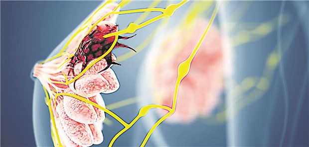 Multigentest hilft, Frauen mit Brustkrebs die Chemo zu ersparen Mithilfe des Multigentests kann bis zu 85 Prozent der Frauen mit Brustkrebs im Frühstadium eine Chemotherapie erspart werden.