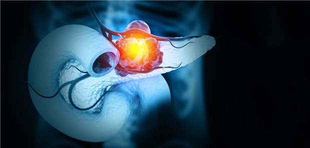 Mithilfe eines Algorithmus konnten die Forscher für den zeitlichen Verlauf ab 36 Monate vor dem Auftreten des Pankreaskarzinoms bis zum Zeitpunkt der Diagnose eine signifikante negative Korrelation mit der viszeralen und subkutanen Fettmasse feststellen: Die Fettmasse nahm während dieser Spanne stetig ab, erst geringer, dann deutlicher.