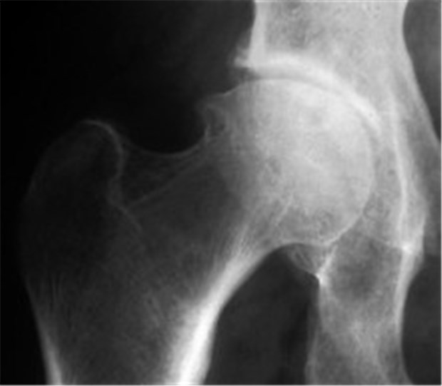 Vorteile für Etoricoxib bei Arthroseschmerz Mittegradiges Stadium einer Coxarthrose.