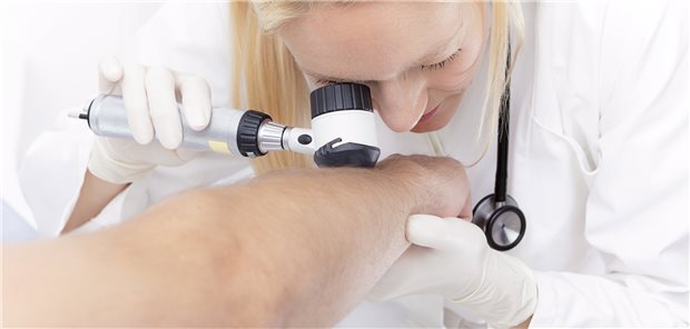Mittels Dermatoskopie lässt sich erkennen, ob der Nävus gutartig ist, oder ob sich um ein Melanom handelt.
