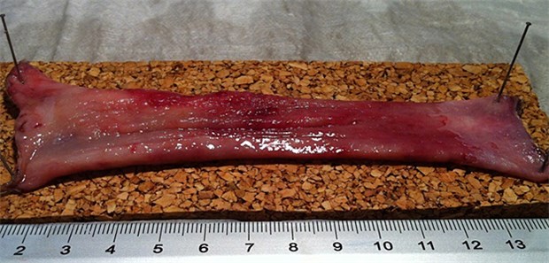 Mittels endoskopischer Submukosadissektion (ESD) schlauchförmig ausgeschältes und invertiertes
En-bloc-Resektat der Ösophagus-Schleimhaut mit flächigem Barrett-Frühkarzinom, RO-reseziert.