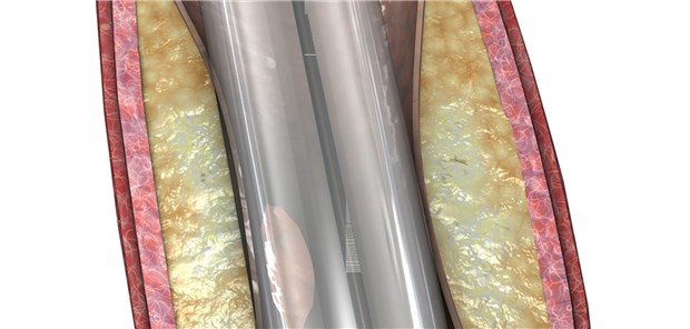 Modell einer Ballondilatation bei PAVK.