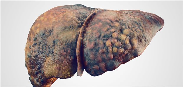 Modell einer zirrhotischen Leber.