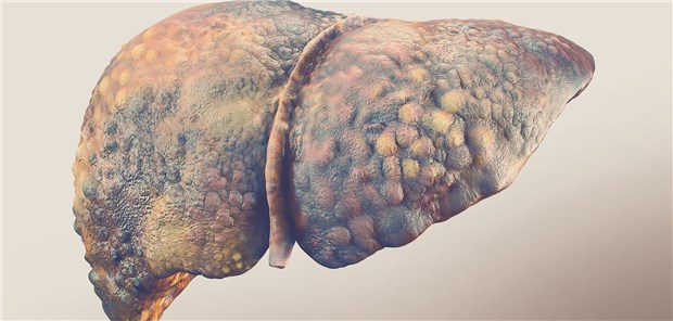 Modell einer zirrhotischen Leber: Um ein Leben retten zu können, müssen nach Ergebnissen einer Studie sieben Zirrhose- Patienten eine Albuminlangzeittherapie erhalten.