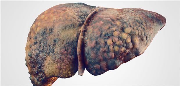 Modell einer zirrhotischen Leber: Viele Lebererkrankungen werden erst so spät entdeckt, dass das Organ schon schwer geschädigt ist.