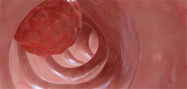 Dickdarmkrebs: 70 Prozent wird frühzeitig erkannt Modell eines Tumors im Darm.