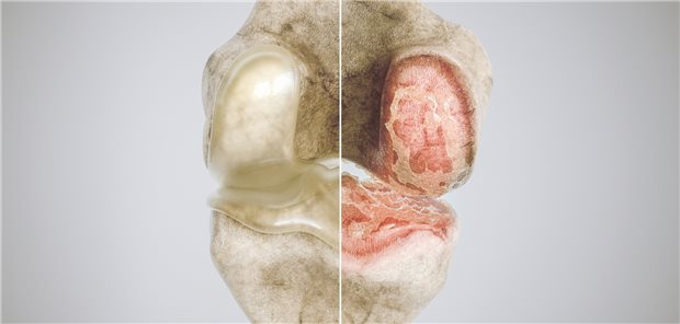 Modell eines gesunden Knies und Situation bei Gelenkverschleiß: Nach wie vor wird nach effizienten Therapien bei Gonarthrose gesucht.
