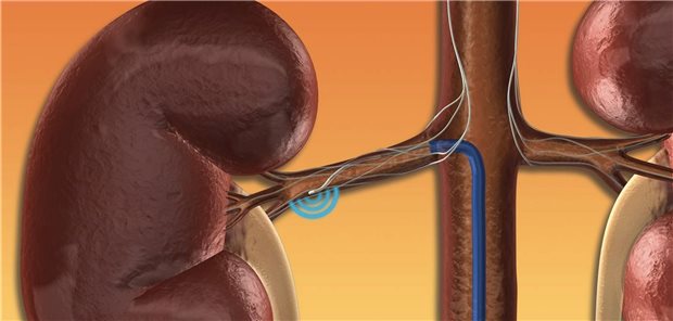 Modell zur Technik der renalen Denervation: Welche Hypertonie-Patienten profitieren wie lange von dieser Intervention?