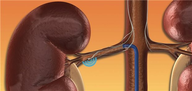 Modell zur Technik der renalen Denervation
