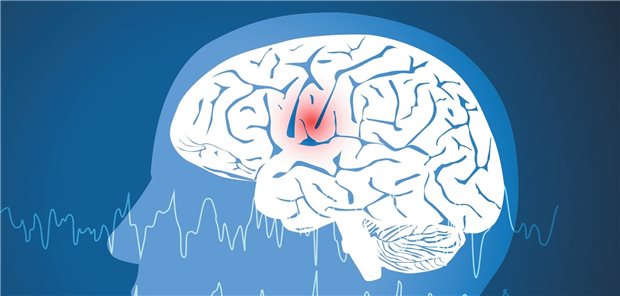 Modellbild fokale Epilepsie: Anfälle dabei gehen bekanntlich nur von einem bestimmten Bereich des Gehirns aus.