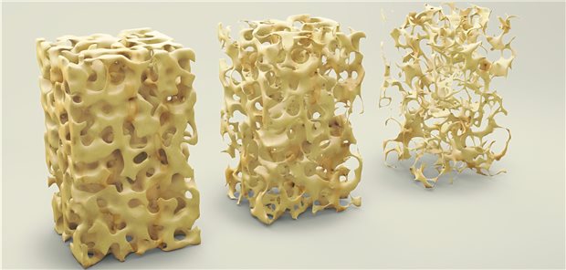 Modelle der Knochenstruktur – von gesundem Knochen bis zu stärkstem Knochenabbau.