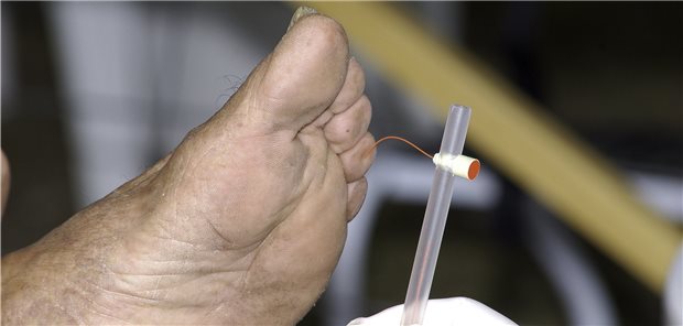 Monofilament-Test zu Überprüfung der Sensitivität auf der Fußhaut.