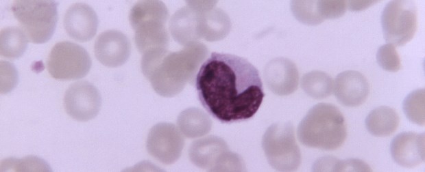 Herzinfarkt beschleunigt Atherosklerose Monozyte in rot: Verdächtiger bei Artherosklerose.