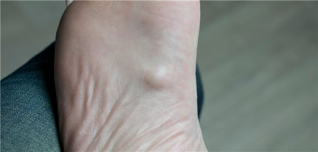 Morbus Ledderhose: Die bisher angewendeten Behandlungen (Operationen, Strahlentherapie, Injektionen) zielen darauf ab, das Fortschreiten der Erkrankung zu verhindern, Schmerzen zu lindern und Funktionsdefizite zu mindern.