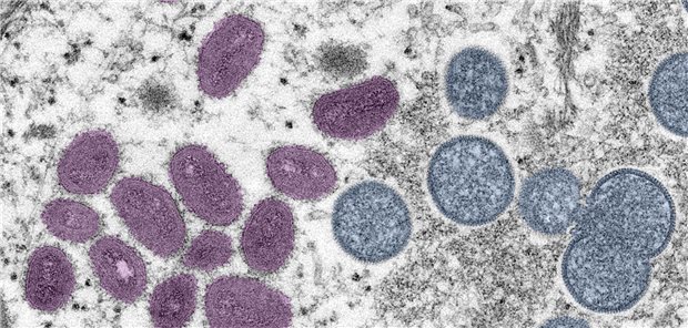 Mpox: Die Ausbreitung von Mpox kurz nach der Corona-Pandemie führte zu großen Befürchtungen über eine neue weltweite Gesundheitsbedrohung. Seit dem Sommer sind die Zahlen aber deutlich gesunken.