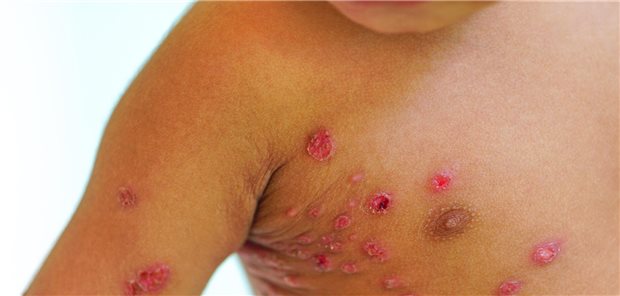 Mpox-Infektion: Bislang hat sich die Lage weltweit nicht verbessert. Das Virus breitet sich weiter aus.